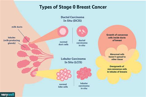 Is Stage Zero Cancer Really Cancer - CancerWalls