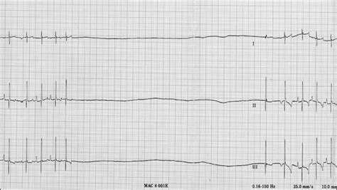 ECG Interpretation