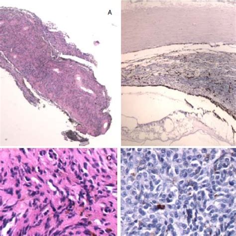 Histology (H&E stain) of A and C) no.12, shows a spindle cell iris... | Download Scientific Diagram