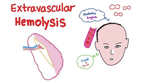 Extravascular Hemolysis - YouTube