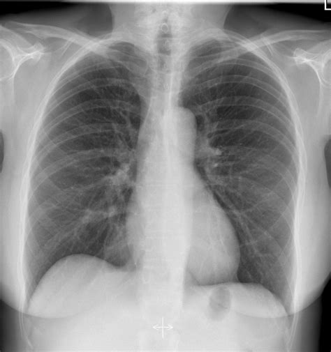 Neat How To Report Normal Chest X Ray Write A Good Introduction For Research