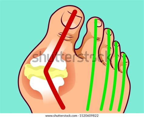 Foot with gout, before-after. Vector illustration