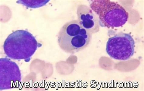 Myelodysplastic Syndrome - Causes, Symptoms, Prognosis & Treatment