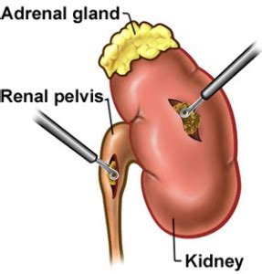 Pyelolithotomy Surgery in New Delhi | ID: 7806136512