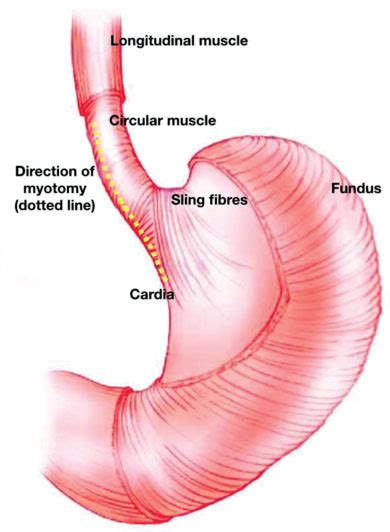 Location of the sling fibers of the gastroesophageal sphincter and the... | Download Scientific ...