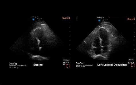 Comparison of the Quality of Echocardiography Imaging Between the Left Lateral Decubitus and ...