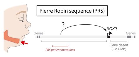 Pierre Robin Syndrome: Causes, Symptoms - Social Psychology