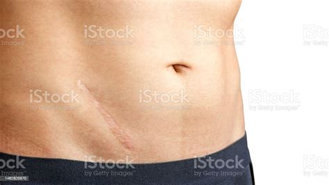 Scars Removal Concept Closeup Of Young Man With Large Scar After ...