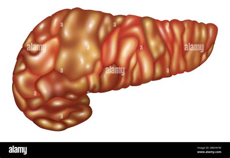 Illustration of an inflamed pancreas (Pancreatitis). Pancreatitis may ...