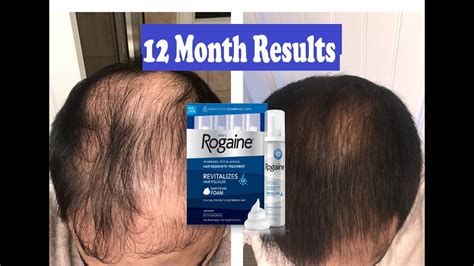 Does Rogaine REALLY Work??? 12 Month RESULTS | MENS ROGAINE (5% ...