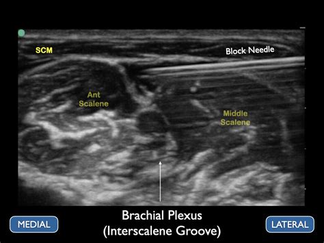 Interscalene — Highland EM Ultrasound Fueled pain management