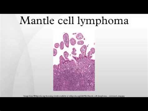 Mantle cell lymphoma - YouTube