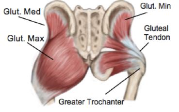 Chronic Gluteal Tendinopathy