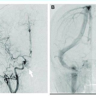 Cerebral angiography performed before the operation. (A) Angiogram of... | Download Scientific ...