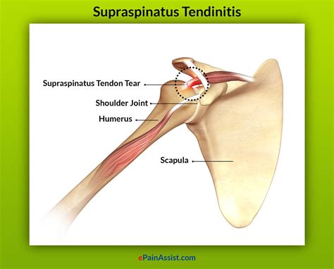 Supraspinatus Tendonitis Causes Symptoms Treatment | Hot Sex Picture