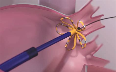 Atrial Fibrillation (AF) Pulsed Field Ablation (PFA) | Centre Medical