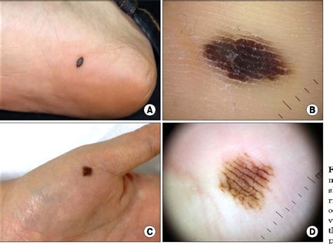 Figure 6 from Cutaneous Melanoma in Asians | Semantic Scholar