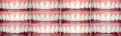 How To Choose The Best Veneers - Tips & Proven Techniques