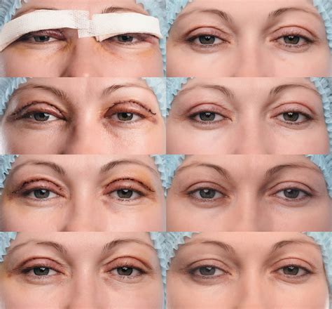 Exercise After Blepharoplasty ⋆ NinaTay.com