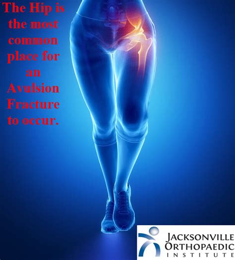 Avulsion Fractures - JOI Jacksonville Orthopaedic Institute