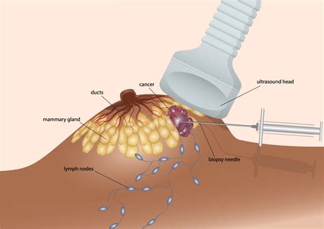 Breast Cryoablation in Albuquerque and Santa Fe - XRANM