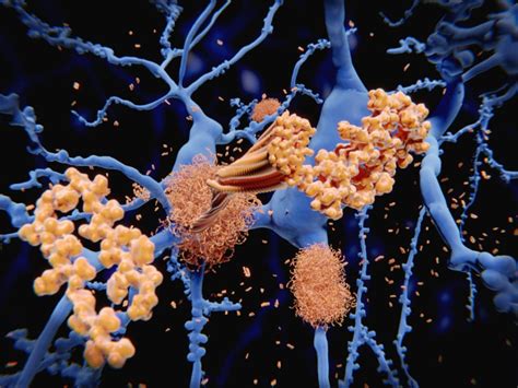 ADUHELM (aducanumab-avwa) for the Treatment of Alzheimer’s Disease