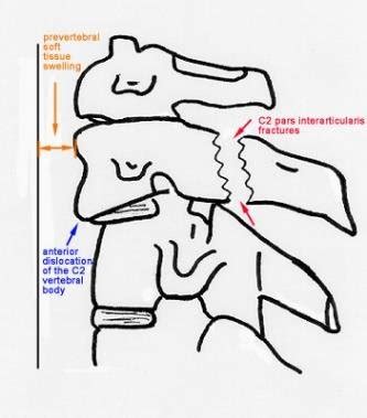 Hitting the dashboard Figure 9: Hangman's fracture often causes ...