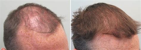 Finasteride Before and After Photos [2022]