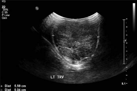 Testicular ultrasound: The testis is large in size with heterogeneous ...