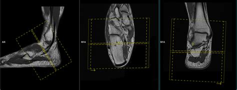 Peroneal tendon MRI protocol and planning