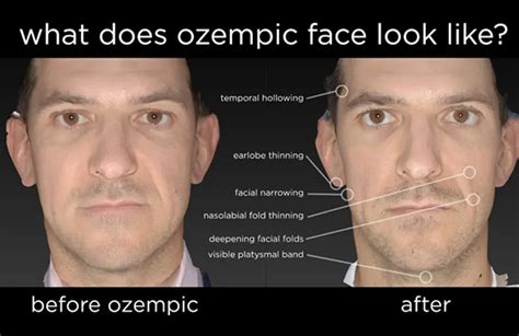 Ozempic Face: The Surgeon's New Challenge in Aesthetic Medicine - Theclockend