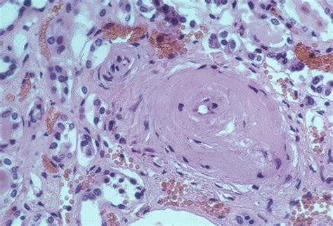 MBBS Medicine (Humanity First): Hyaline Arteriolosclerosis