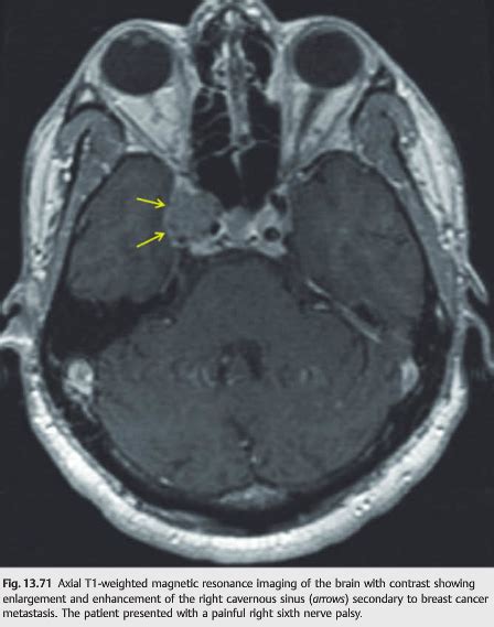 Neuro-ophthalmology Illustrated Chapter 13 – 4 – 6th Nerve Palsy — Neuro-Ophthalmology