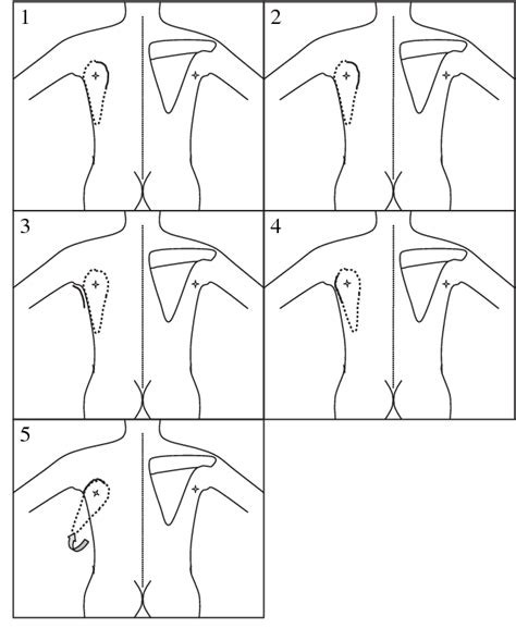 Circumflex scapular artery | Semantic Scholar