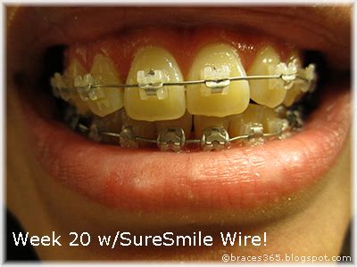 Braces 365: SureSmile Wire!!!!