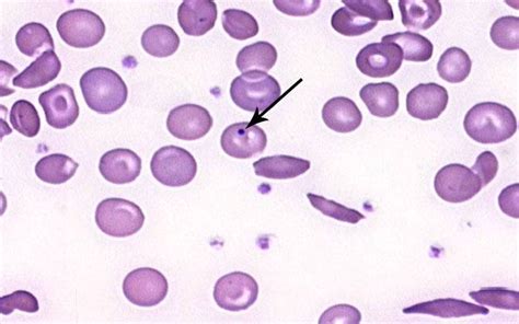 G6PD Deficiency - USMLE Strike