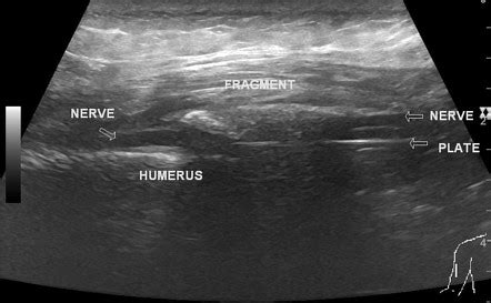 Radial nerve injury (post-traumatic) | Radiology Case | Radiopaedia.org