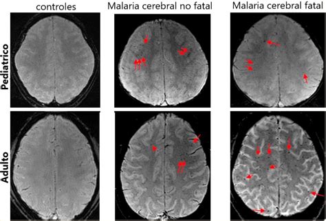 Malaria cerebral: Efectos neuropsicológicos - NeuroClass