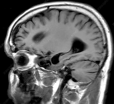 Chronic Post-Traumatic Brain Injury, MRI - Stock Image - C030/6065 ...