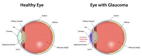 Some Of The Common Eye Diseases In Elderly People - Goggles4u.com