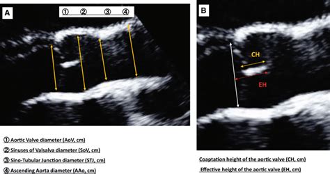 Aortic root anatomy measured using parasternal long-axis view of ...