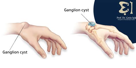 protrusion of the wrist bone; Is it a serious problem? - Dr. What's ...