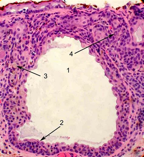 Ocular Pathology: Compound nevus- the answers