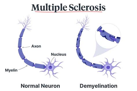 Multiple Sclerosis : In ms the body's immune system attacks myelin, which coats nerve cells.