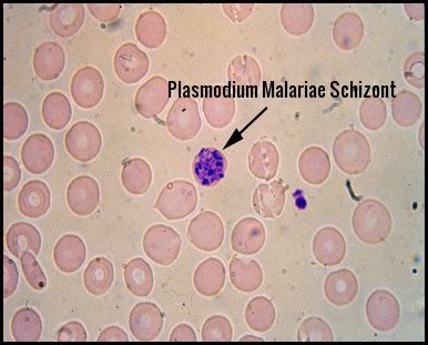 Malaria - Ask Hematologist | Understand Hematology