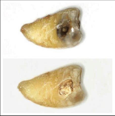 Operative technique: before and after collecting the carious lesion... | Download Scientific Diagram