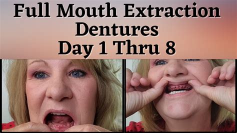 Dentures Day 1 & Full Mouth Extraction in 2023 | Dentures, Mouth, Full