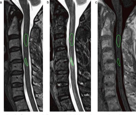 Figure 1 from Comparison of MRI sequences for evaluation of multiple sclerosis of the cervical ...