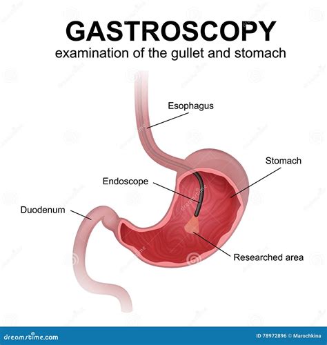 Gastroscopy Cartoons, Illustrations & Vector Stock Images - 1354 Pictures to download from ...