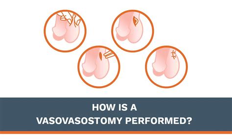 How is a Vasovasostomy Performed? Learn what to Expect